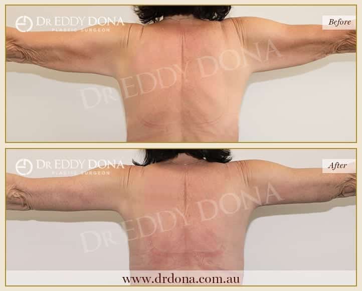 Dr Eddy Dona Arm Lift Before and After