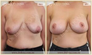 Dr Eddy Dona Breast Implants Before and After