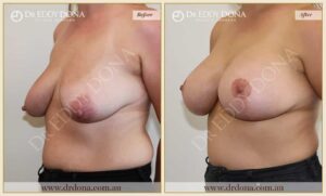 Dr Eddy Dona Breast Implants Before and After