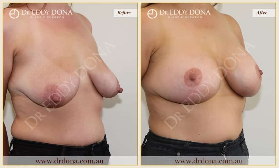 Dr Eddy Dona Breast Implants Before and After