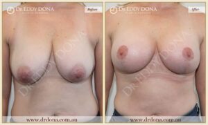 Dr Eddy Dona Breast Augmentation Two Stage Before and After