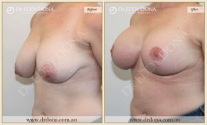 Dr Eddy Dona Breast Augmentation Two Stage Before and After