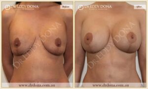 Dr Eddy Dona - Revision Breast Surgery - Before and After