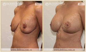 Dr Eddy Dona - Revision Breast Surgery - Before and After