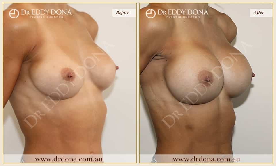 Dr Eddy Dona Breast Augmentation and Exchange of Implants Before and After