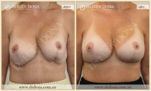 Dr Eddy Dona - Revision Breast Surgery - Before and After