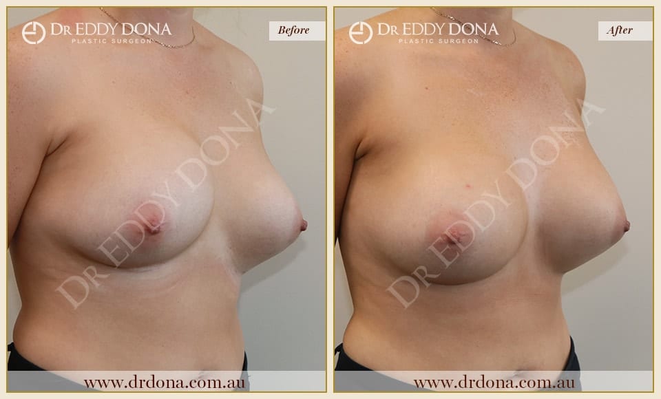 Dr Eddy Dona - Revision Breast Surgery - Before and After