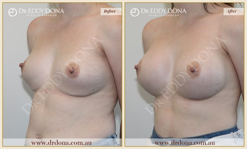 Dr Eddy Dona - Revision Breast Surgery Before and After