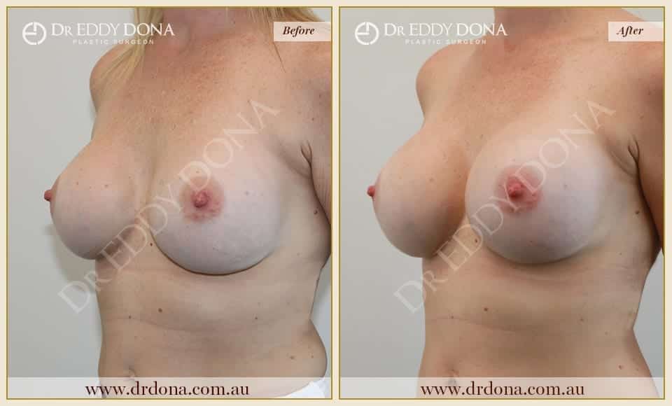 Dr Eddy Dona - Revision Breast Surgery Before and After