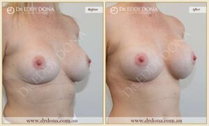 Dr Eddy Dona - Revision Breast Surgery Before and After