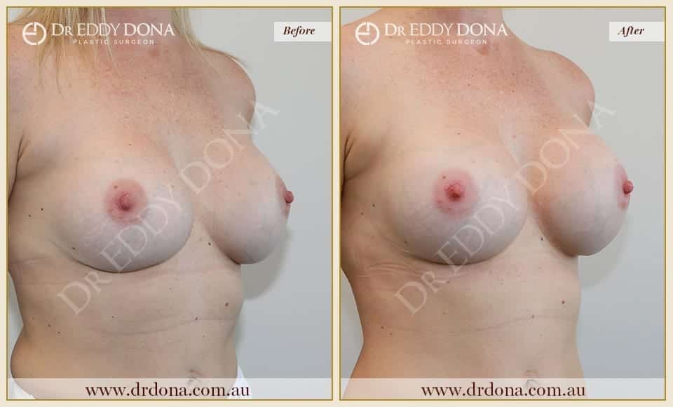 Dr Eddy Dona - Revision Breast Surgery Before and After