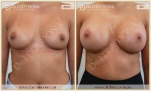 Dr Eddy Dona - Revision Breast Surgery Before and After