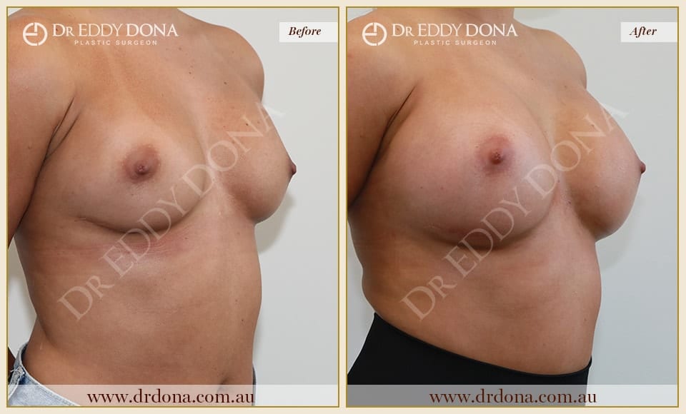 Dr Eddy Dona - Revision Breast Surgery Before and After