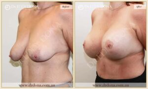 Dr Eddy Dona - Breast Lift and Implants Surgery - Before and After