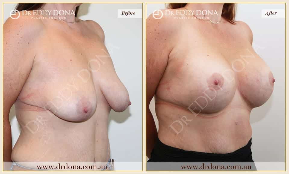 Dr Eddy Dona - Breast Lift and Implants Surgery - Before and After