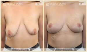 Dr Eddy Dona Breast Lift Before and After