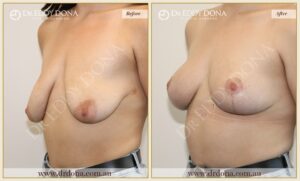 Dr Eddy Dona Breast Lift Before and After