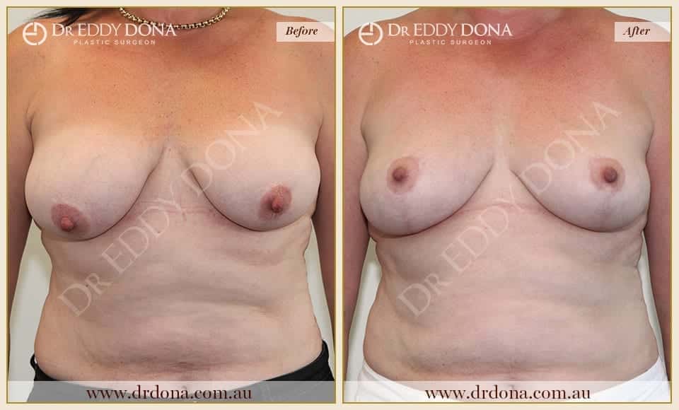 Dr Eddy Dona - Breast Lift Surgery - Before and After