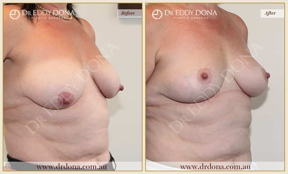 Dr Eddy Dona - Breast Lift Surgery - Before and After