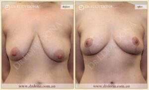 Dr Eddy Dona - Breast lift Surgery - Before and After