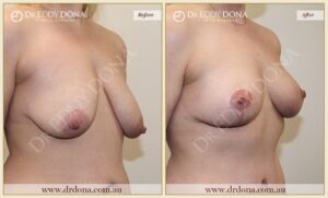 Dr Eddy Dona - Breast Lift Surgery - Before and After