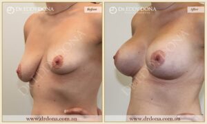 Dr Eddy Dona - Breast Lift and Implants Surgery - Before and After