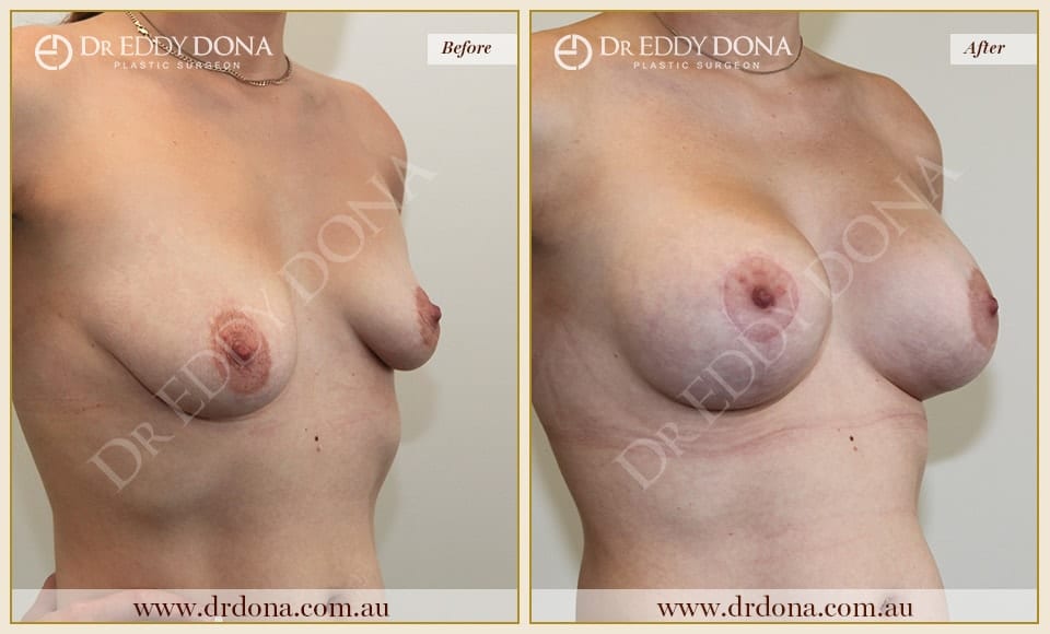 Dr Eddy Dona - Breast Lift and Implants Surgery - Before and After