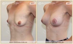 Dr Eddy Dona - Breast Lift and Implants Surgery - Before and After