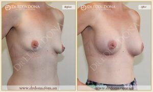 Dr Eddy Dona - Breast Lift and Implants Surgery - Before and After