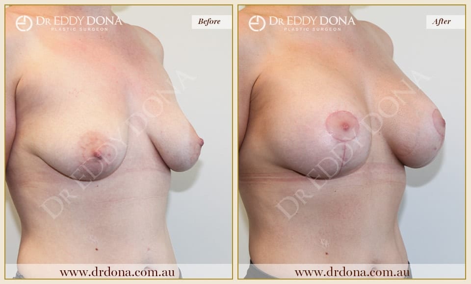 Dr Eddy Dona - Breast Lift and Implants Surgery - Before and After