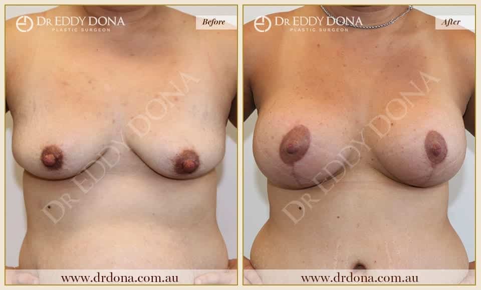 Dr Eddy Dona - Breast Lift and Implants Surgery - Before and After