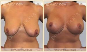 Dr Eddy Dona - Breast Lift and Implants Surgery - Before and After