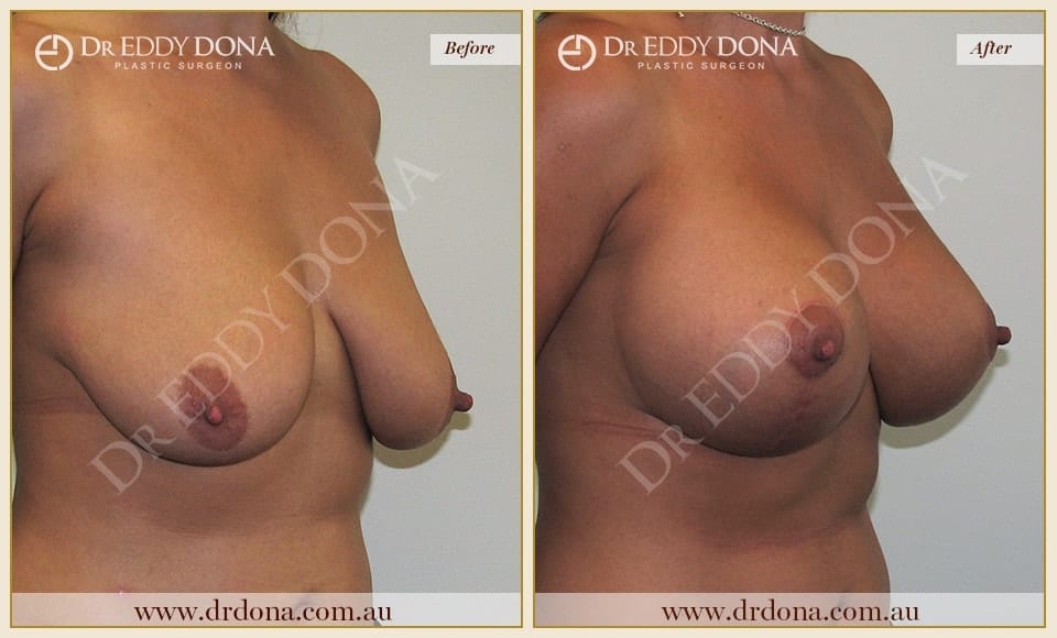 Dr Eddy Dona - Breast Lift and Implants Surgery - Before and After