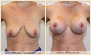 Dr Eddy Dona - Breast Lift and Implants Surgery - Before and After