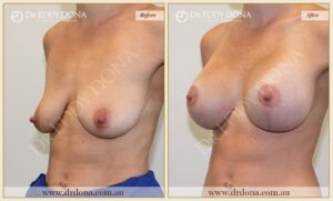 Dr Eddy Dona - Breast Lift and Implants Surgery - Before and After