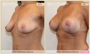 Dr Eddy Dona - Breast Lift and Implants Surgery - Before and After