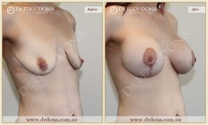 Dr Eddy Dona - Breast Lift and Implants Surgery - Before and After