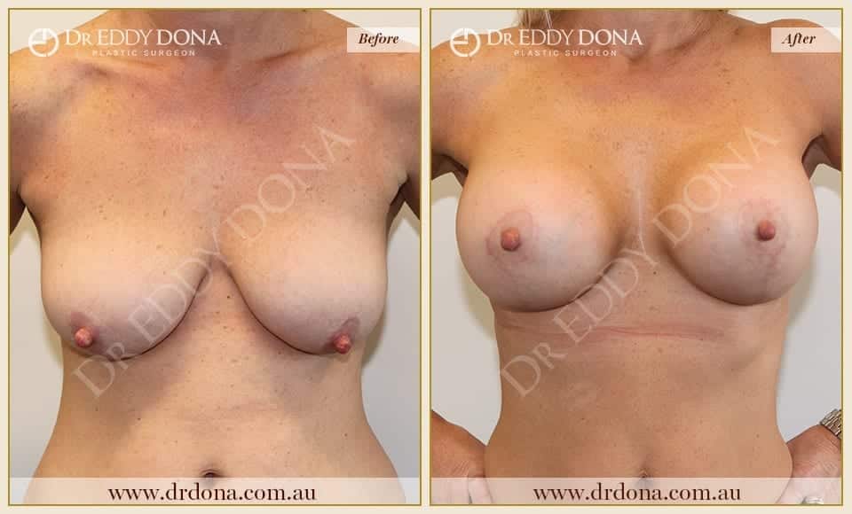 Dr Eddy Dona - Breast Lift and Implants Surgery - Before and After