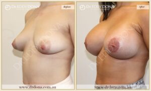 Dr Eddy Dona - Breast Lift and Implants Surgery - Before and After