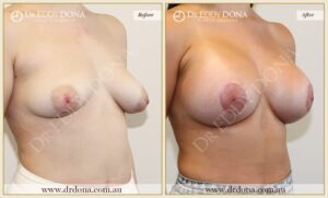 Dr Eddy Dona - Breast Lift and Implants Surgery - Before and After