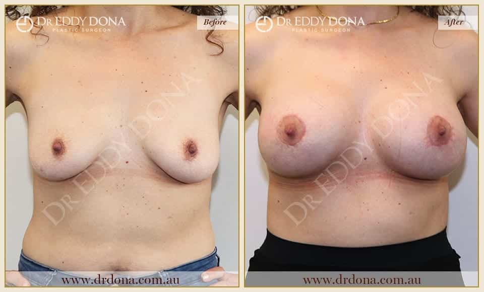 Dr Eddy Dona - Breast Lift and Implants Surgery - Before and After