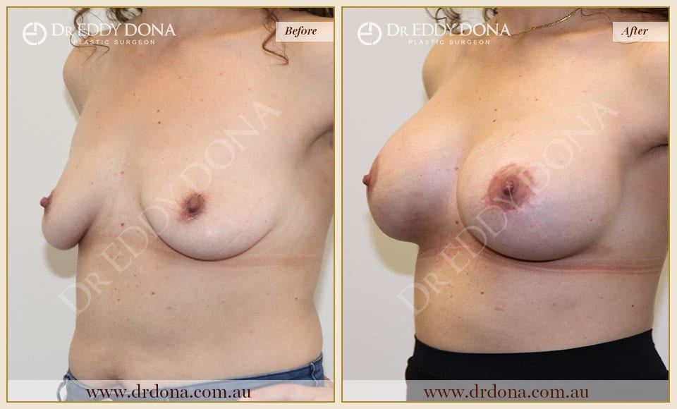 Dr Eddy Dona - Breast Lift and Implants Surgery - Before and After