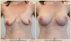 Dr Eddy Dona - Breast Lift and Implants Surgery - Before and After