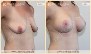 Dr Eddy Dona - Breast Lift and Implants Surgery - Before and After