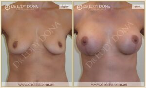 Dr Eddy Dona - Breast Lift and Implants Surgery - Before and After