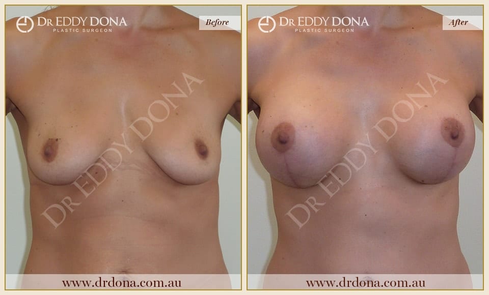 Dr Eddy Dona - Breast Lift and Implants Surgery - Before and After