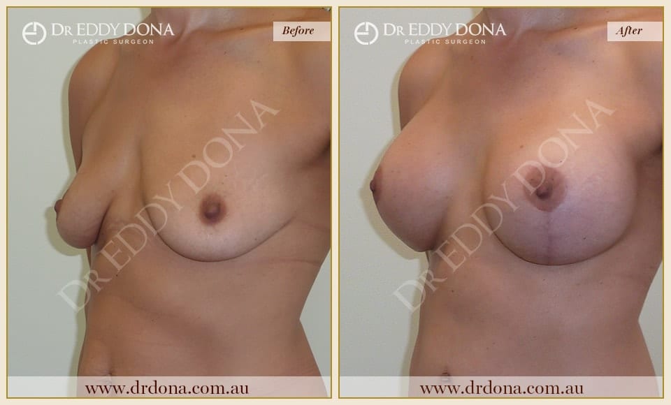 Dr Eddy Dona - Breast Lift and Implants Surgery - Before and After