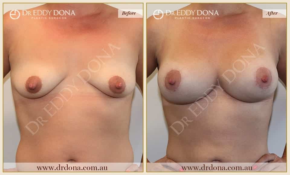 Dr Eddy Dona - Breast Lift and Implants Surgery - Before and After