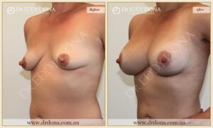 Dr Eddy Dona - Breast Lift and Implants Surgery - Before and After