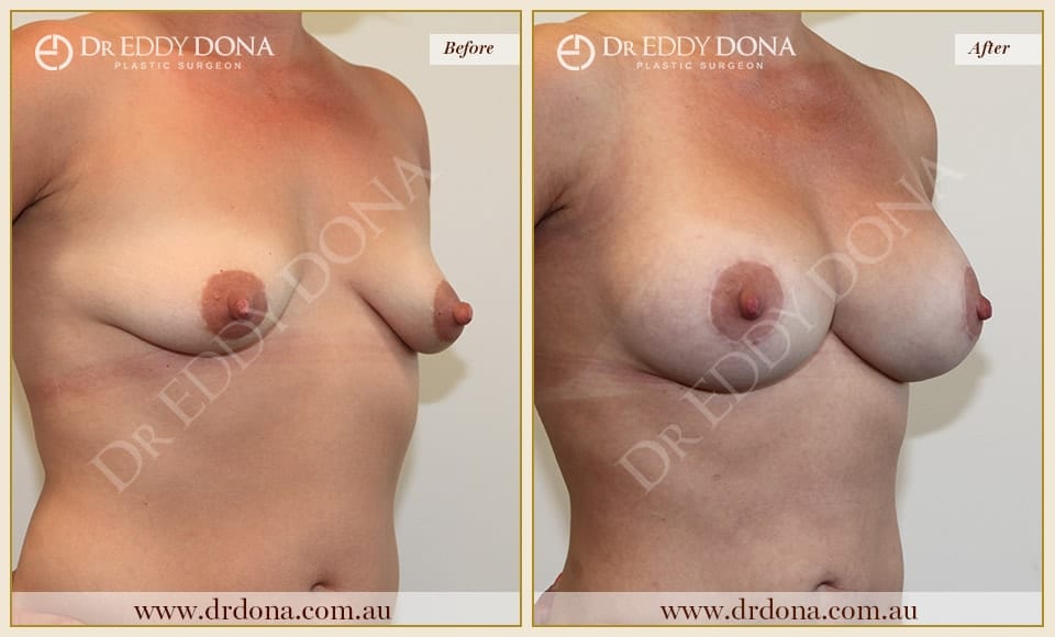 Dr Eddy Dona - Breast Lift and Implants Surgery - Before and After